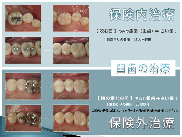 もの 歯 値段 かぶせ 歯のつめ物・かぶせ物 材質の違い＆料金表